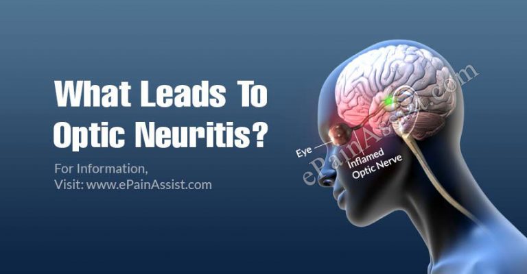 What Leads To Optic Neuritis & Can It Be Cured?