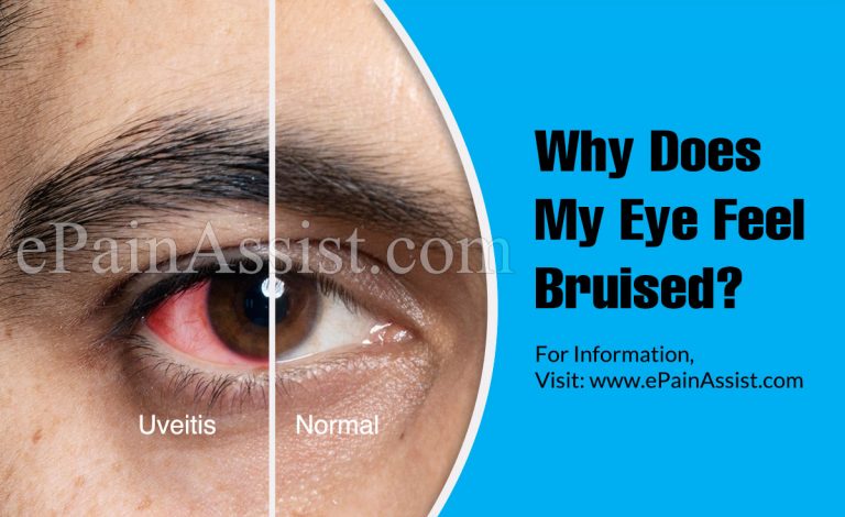 Why Does My Eye Feel Bruised?