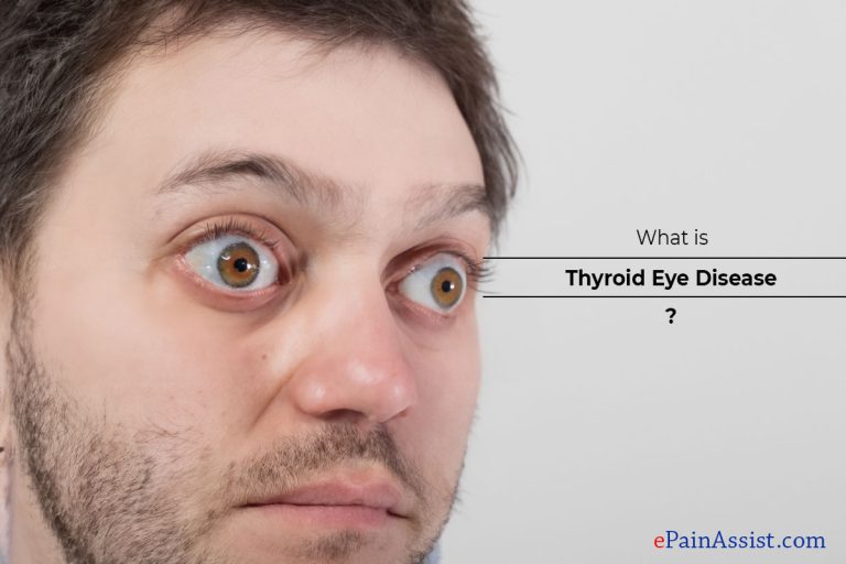 Exploring The Impact Of Thyroid Eye Disease On Quality Of Life