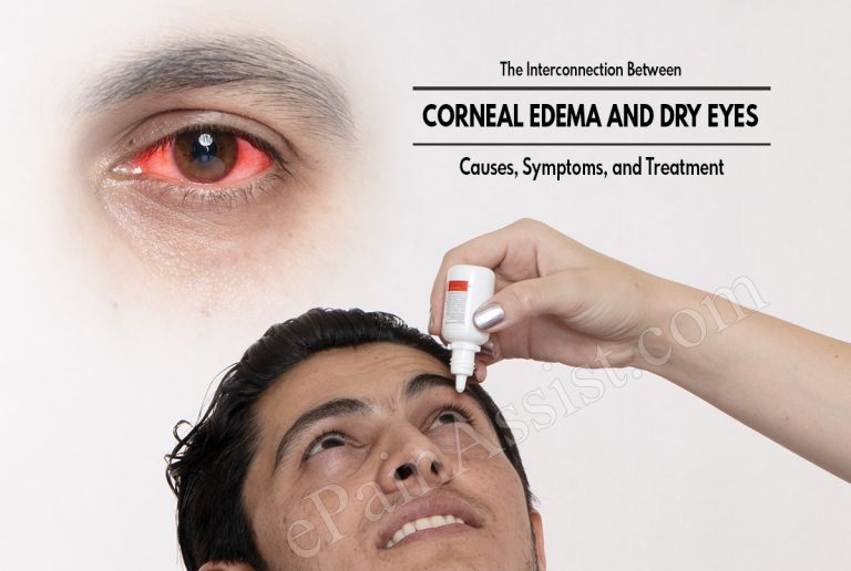 The Interconnection Between Corneal Edema and Dry Eyes : Causes, Symptoms, and Treatment