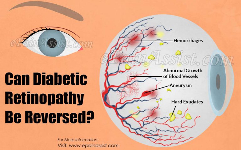 Can Diabetic Retinopathy Be Reversed?