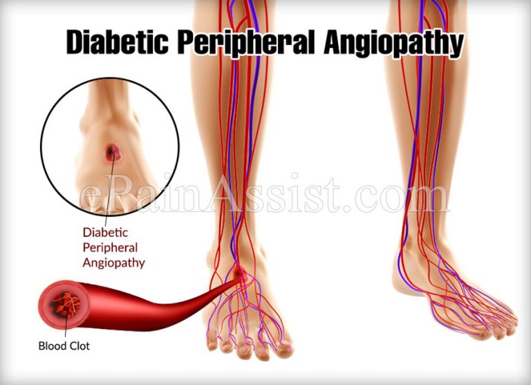 Diabetic Peripheral Angiopathy: Causes, Symptoms, Treatments, Prevention, Diagnosis