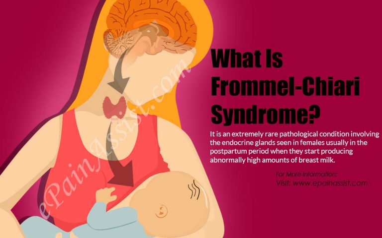 Frommell-Chiari Syndrome : Causes, Symptoms, Treatment
