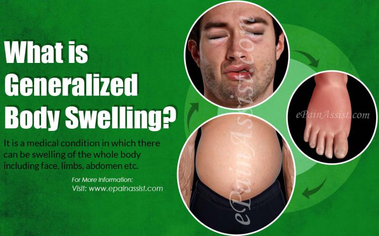 Generalized Body Swelling – Causes, Symptoms, Treatment Home Care and Diet