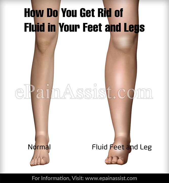 How Do You Get Rid of Fluid in Your Feet and Legs?