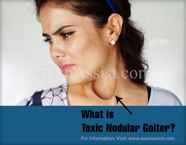 Toxic Nodular Goiter or Plummer Disease : Causes, Symptoms, Treatment, Complications