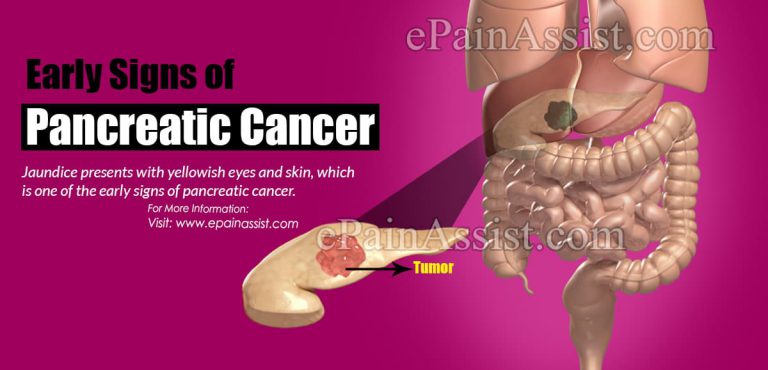 Early Signs of Pancreatic Cancer & Can Pancreatic Cancer Be Cured?