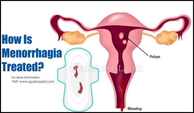How Is Menorrhagia Treated?