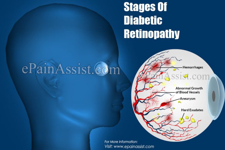 Stages Of Diabetic Retinopathy