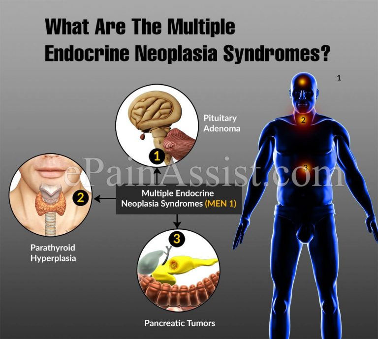 What Are The Multiple Endocrine Neoplasia Syndromes?