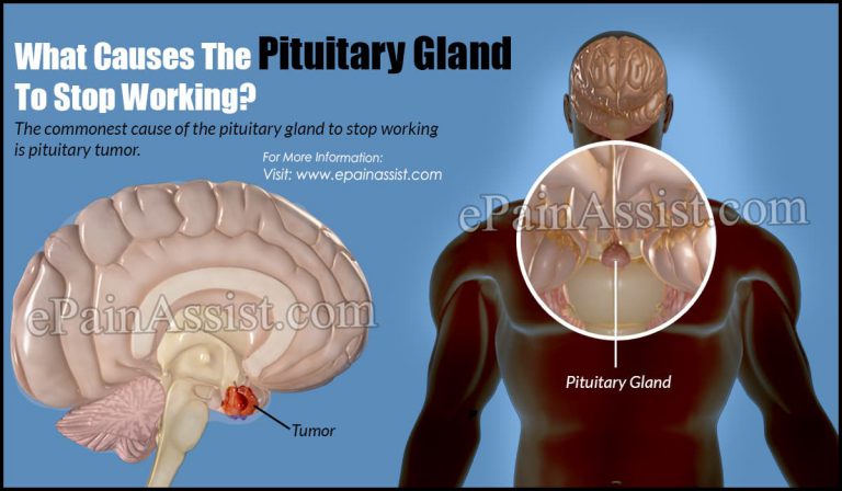 What Causes The Pituitary Gland To Stop Working? | What Is The Removal Of The Pituitary Gland Called?