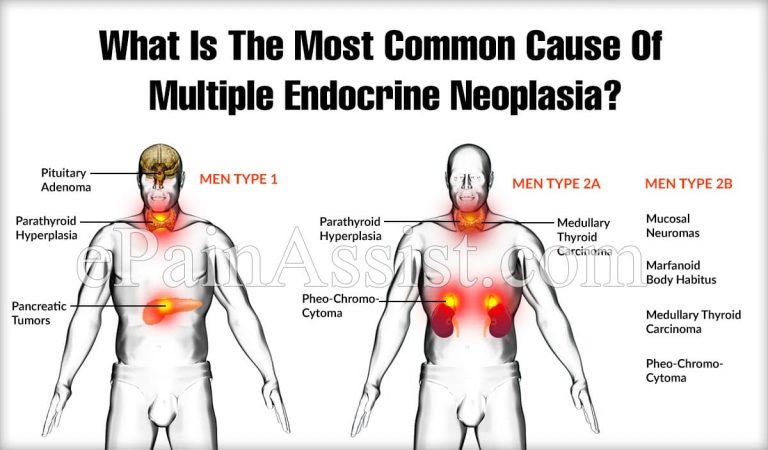 What Is The Most Common Cause Of Multiple Endocrine Neoplasia?