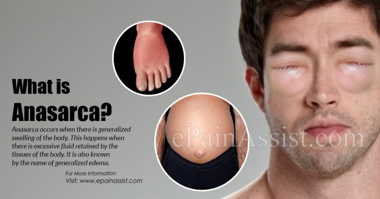 Anasarca: Causes, Symptoms, Treatment, Diagnosis