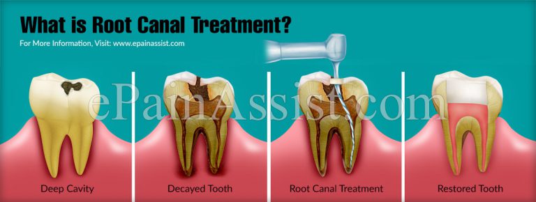 Root Canal Treatment – The Process, Do’s & Don’ts, Side Effects