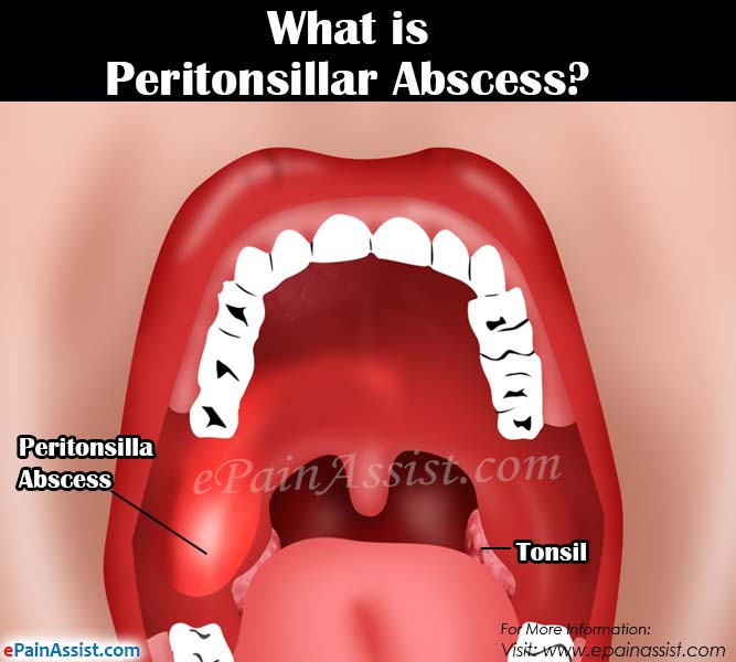 What is Peritonsillar Abscess or Quinsy?