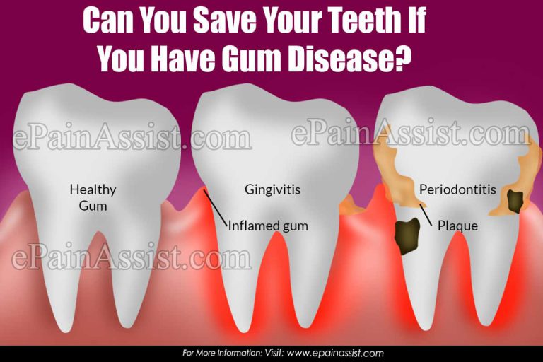 Can You Save Your Teeth If You Have Gum Disease?