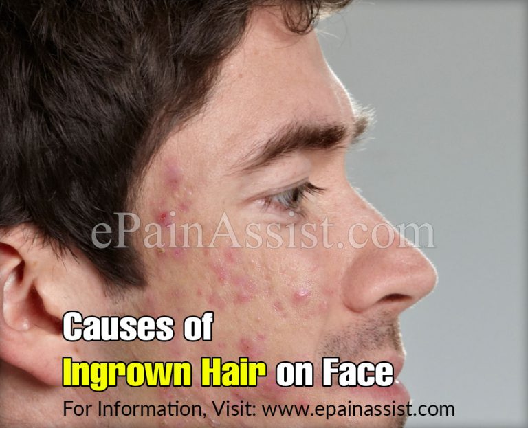 Causes of Ingrown Hair on Face & Tips to Deal With It