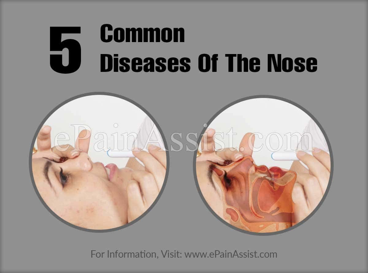 5 Common Diseases Of The Nose