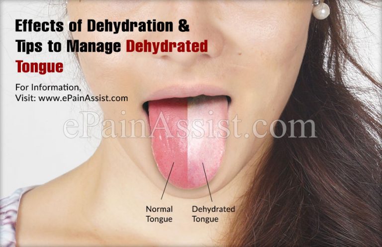 Dehydrated Tongue : Effects of Dehydration & Tips to Manage Dehydrated Tongue