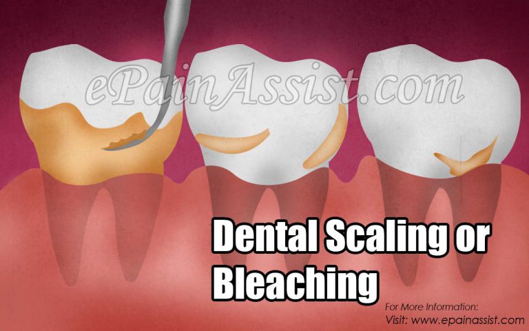Dental Scaling or Bleaching: When is Dental Bleaching Done & Ways to Bleach the Teeth