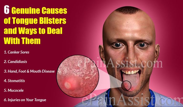 6 Genuine Causes of Tongue Blisters and Ways to Deal With Them