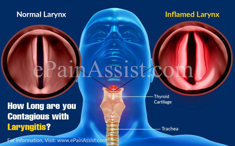 How Long Are You Contagious With Laryngitis?