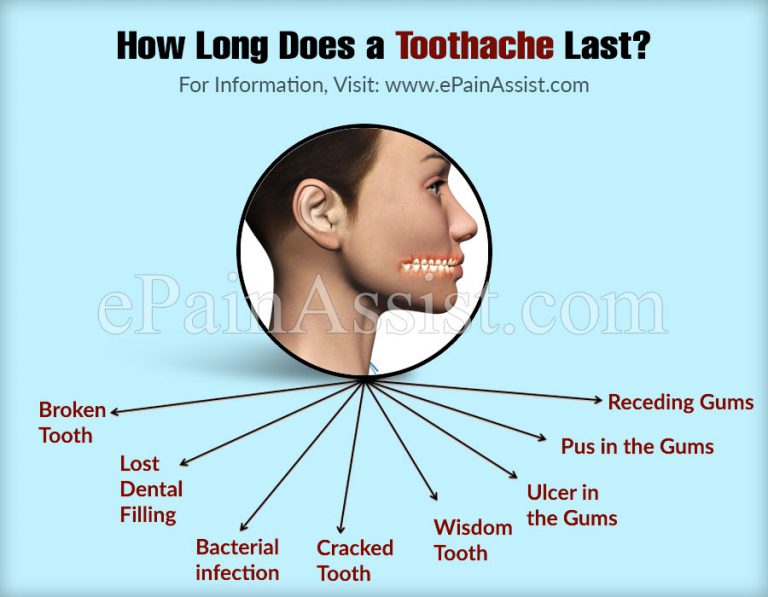 How Long Does A Toothache Last & The Best Painkillers For Toothaches?