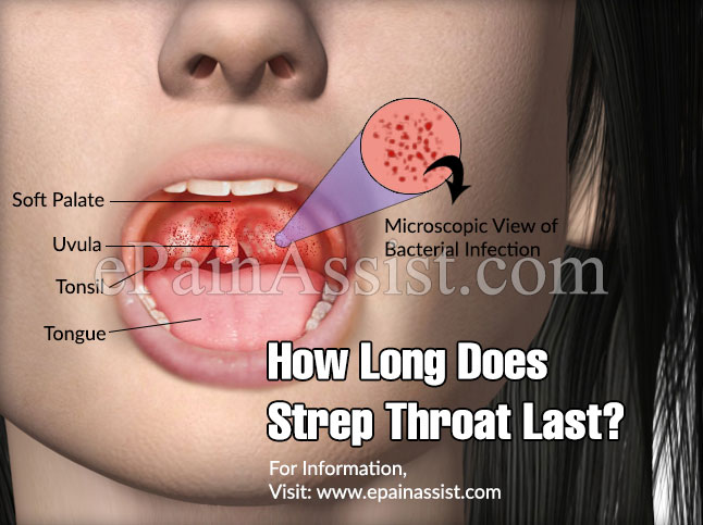 How Long Does Strep Throat Last?