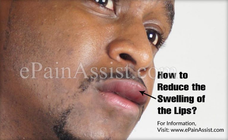 How to Reduce the Swelling of the Lips?