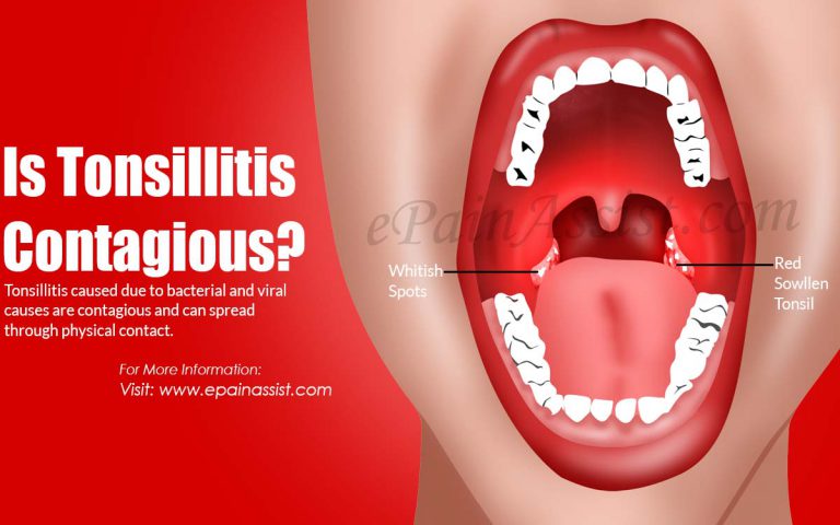 How Does Tonsillitis Feel Like & Is Tonsillitis Contagious?