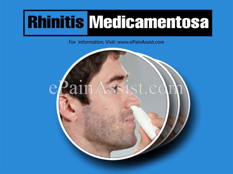 Rhinitis Medicamentosa: Causes, Symptoms, Treatment, Diagnosis, Prevention