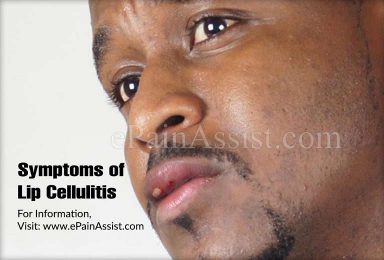 Lip Cellulitis: Causes, Symptoms, How Long Does It Last, Treatment, Natural Remedies