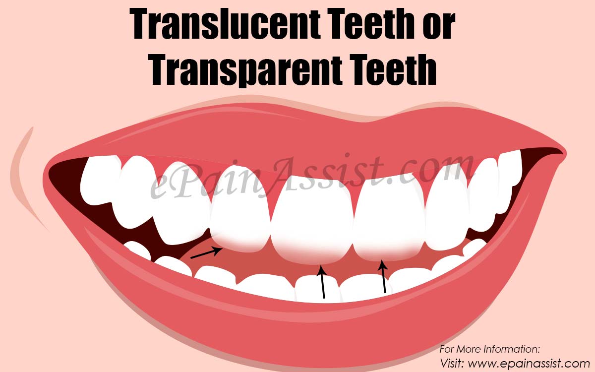 How to fix translucent teeth