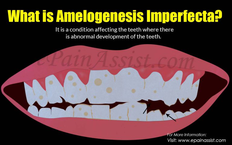 What is Amelogenesis Imperfecta: Causes, Symptoms, Treatment, Prognosis, Complications