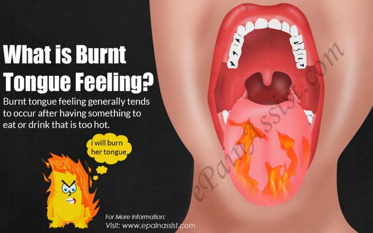 What is Burnt Tongue Feeling, Causes, Symptoms, Treatment