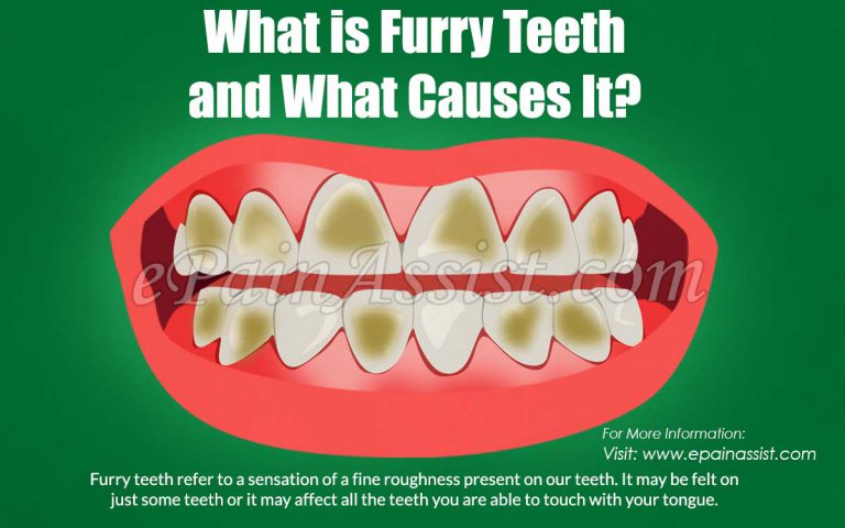 What Is Furry Teeth Feeling, Causes, Way to Get Rid of it