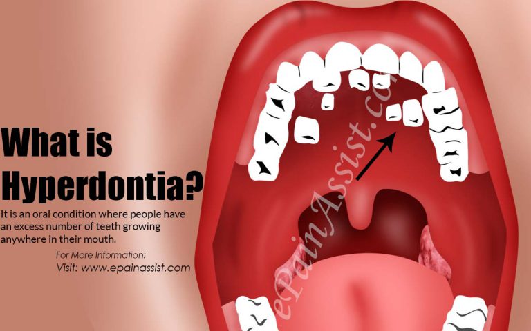 What is Hyperdontia: Types, Causes, Symptoms, Treatment, Diagnosis
