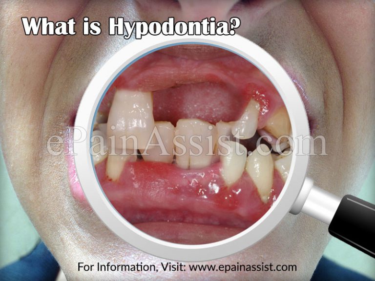 What is Hypodontia: Causes, Treatment
