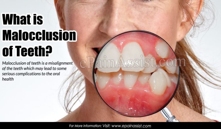 What is Malocclusion of Teeth: Symptoms, Causes, Types, Treatment, Prognosis, Prevention
