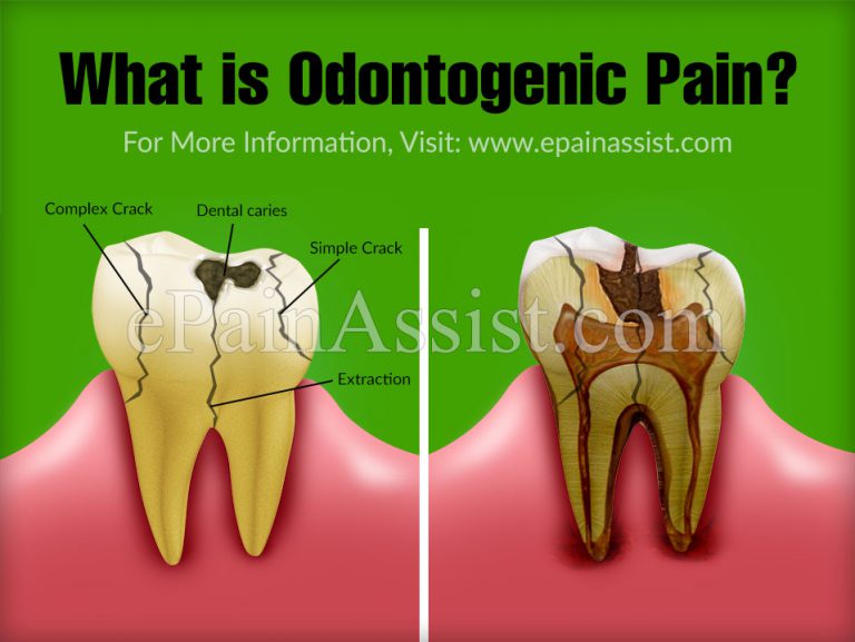 What is Odontogenic Pain & What are the Different Types of Odontogenic Pain