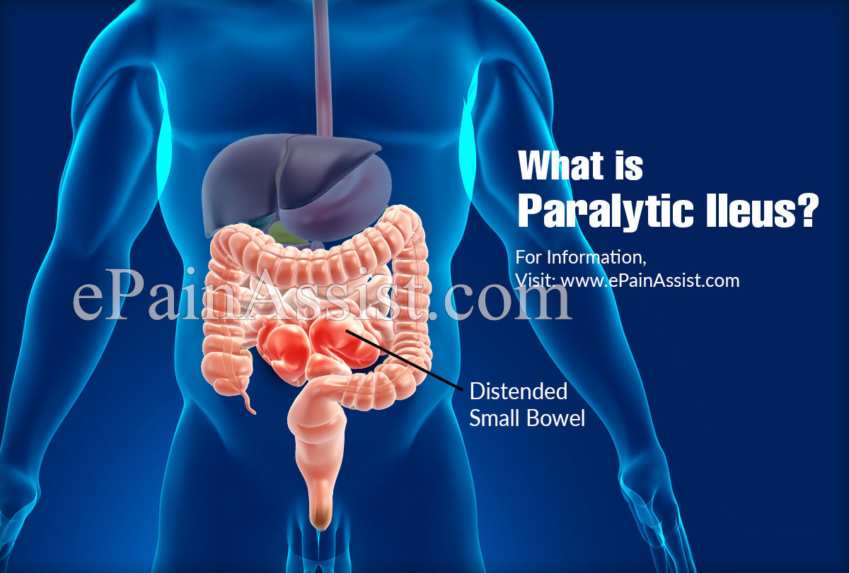 What Is Paralytic Ileus And How Is It Treatedcauses Symptoms Complications Of Paralytic Ileus 