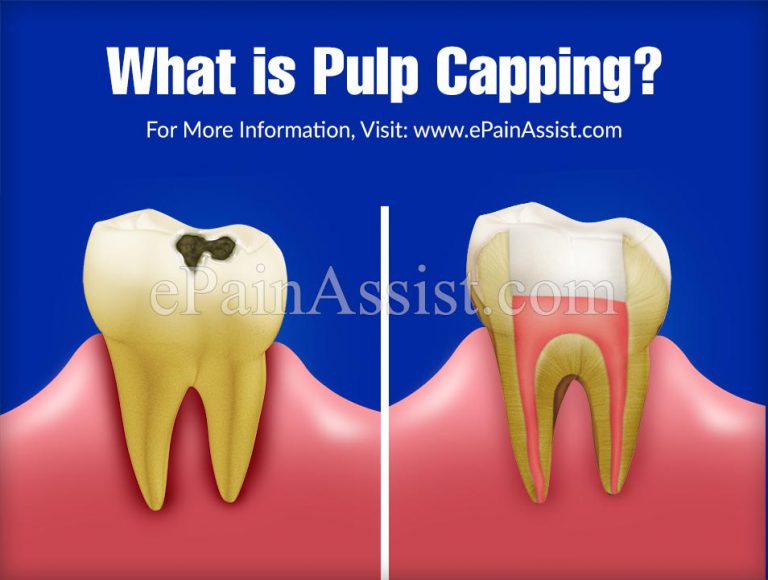 What is Pulp Capping: Types, How is Pulp Capping Done, Success & Prognosis of Pulp Capping