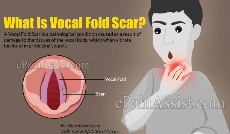 What is Vocal Fold Scar: Causes, Symptoms, Treatment, Diagnosis