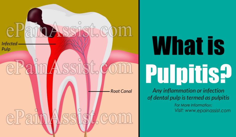 Pulpitis: Types, Causes, Symptoms, Treatment, Risk Factors, Prevention, Diagnosis