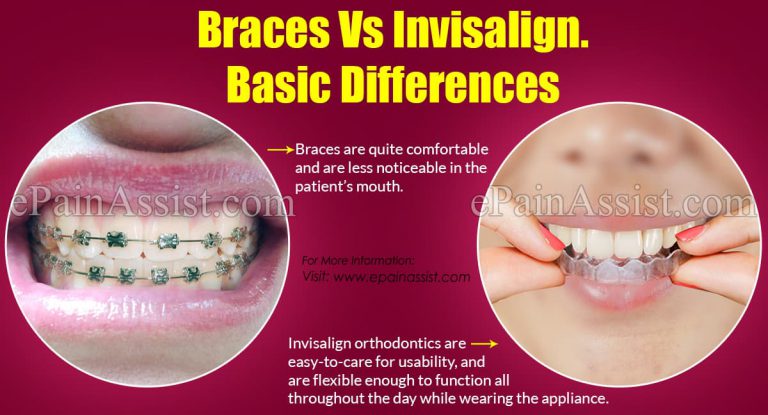 Braces Vs Invisalign:  Differences Based on Colors, Treatment Times, Cost, Pros, Cons
