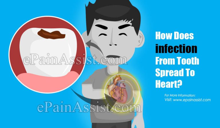 Can A Tooth Infection Spread To Your Heart?
