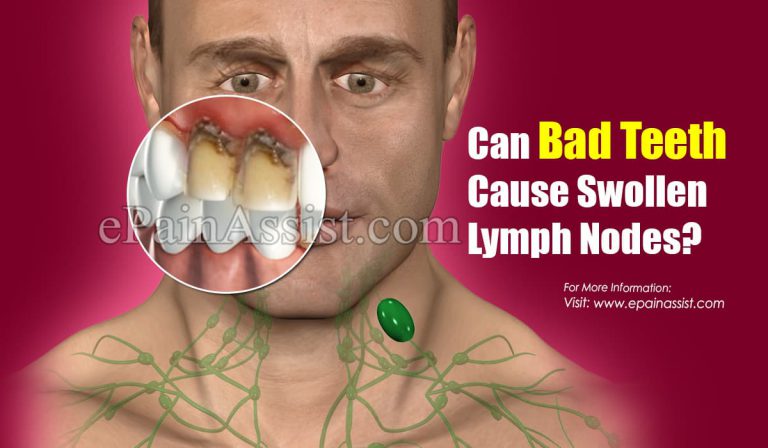 Can Bad Teeth Cause Swollen Lymph Nodes?