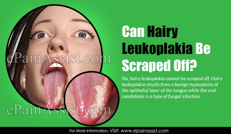 Can Hairy Leukoplakia Be Scraped Off?