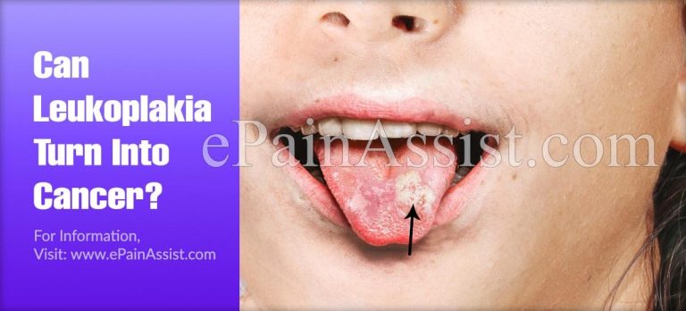 Can Leukoplakia Turn Into Cancer?