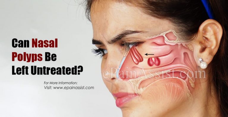 Can Nasal Polyps Be Left Untreated & When To Go To Doctor?